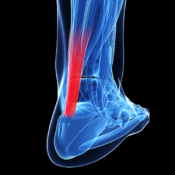 Τενοντίτιδα αχιλλείου τένοντα